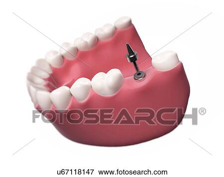 Stock Illustration - Dental implant, illustration. Fotosearch