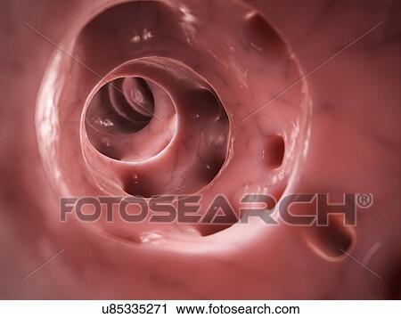 Diverticulitis, illustration View Large Illustration Clip Art - Diverticulitis, illustration. Fotosearch