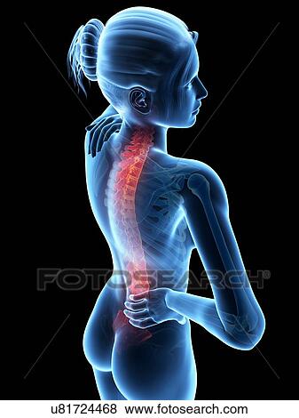 Stock Illustration - Human back pain, illustration. Fotosearch