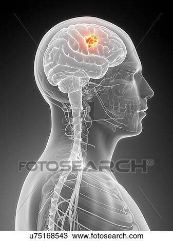 Drawing - Human brain tumor, illustration. Fotosearch