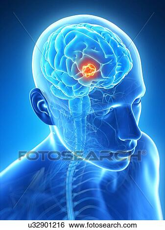 Stock Illustration - Human brain tumor, illustration. Fotosearch