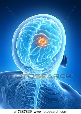 Human brain tumor, illustration View Large Illustration Stock Illustration - Human brain tumor, illustration. Fotosearch