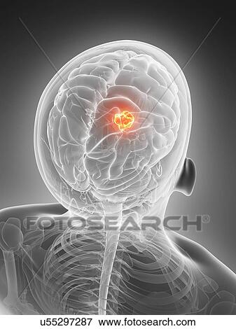 Stock Illustration - Human brain tumor, illustration. Fotosearch