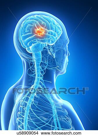 Stock Illustration - Human brain tumor, illustration. Fotosearch
