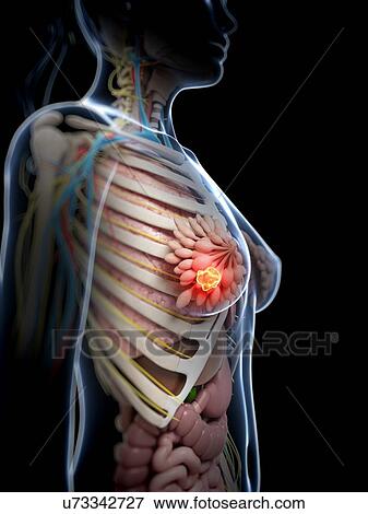Stock Illustration - Human breast cancer, illustration. Fotosearch