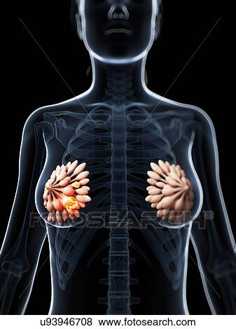 Stock Illustration - Human breast cancer, illustration. Fotosearch
