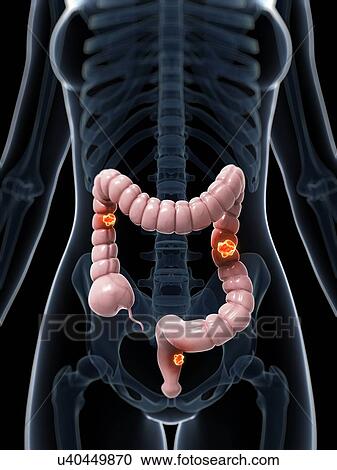 Human colon cancer, illustration View Large Illustration Clipart - Human colon cancer, illustration. Fotosearch