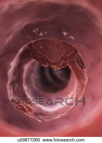 Clipart - Human colon cancer, illustration. Fotosearch