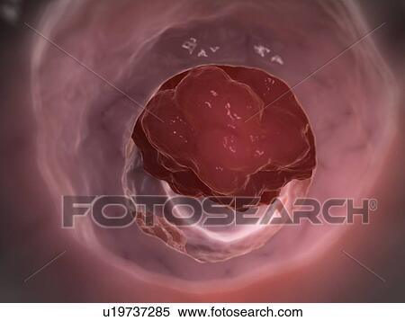 Human colon cancer, illustration View Large Illustration Stock Illustration - Human colon cancer, illustration. Fotosearch