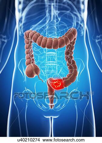 Stock Illustration - Human colon cancer, illustration. Fotosearch