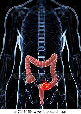 Stock Illustration - Human colon cancer, illustration. Fotosearch