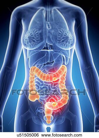 Stock Illustration - Human colon cancer, illustration. Fotosearch