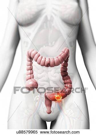 Human colon cancer, illustration View Large Illustration Stock Illustration - Human colon cancer, illustration. Fotosearch