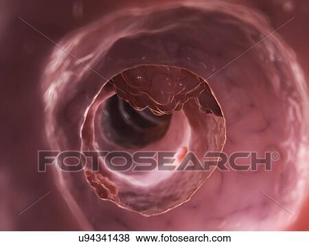 Human colon cancer, illustration View Large Illustration Stock Illustration - Human colon cancer, illustration. Fotosearch