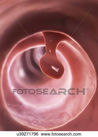 Human colon polyp, illustration View Large Illustration Stock Illustration - Human colon polyp, illustration. Fotosearch