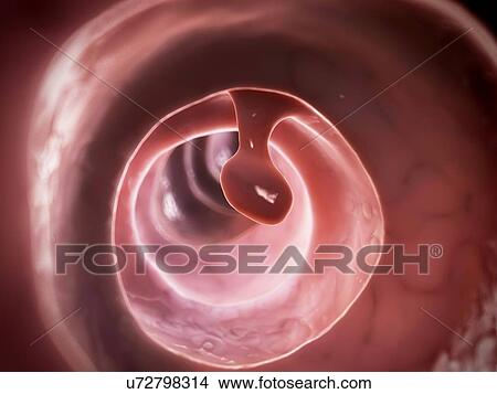 Stock Illustration - Human colon polyp, illustration. Fotosearch