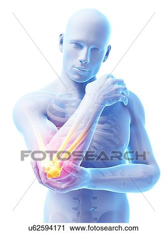 Clip Art - Human elbow pain, illustration. Fotosearch