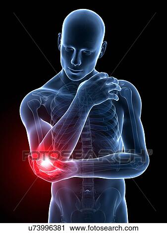 Clip Art - Human elbow pain, illustration. Fotosearch