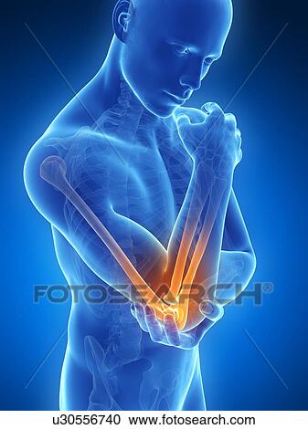 Clipart - Human elbow pain, illustration. Fotosearch