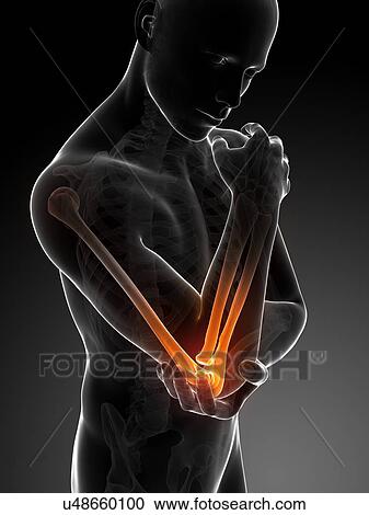 Clipart - Human elbow pain, illustration. Fotosearch
