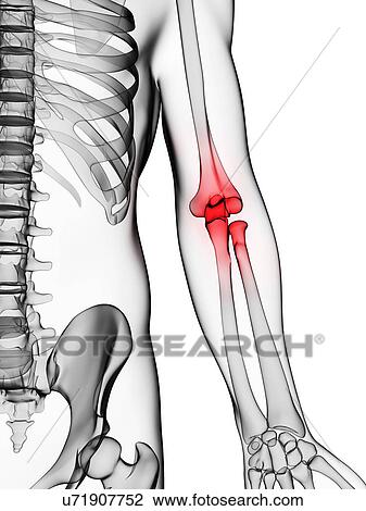 Drawing - Human elbow pain, illustration. Fotosearch