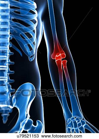 Drawing - Human elbow pain, illustration. Fotosearch