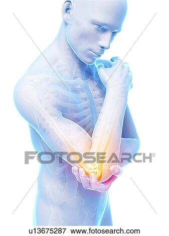 Stock Illustration - Human elbow pain, illustration. Fotosearch