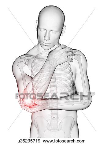 Stock Illustration - Human elbow pain, illustration. Fotosearch