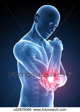 Human elbow pain, illustration View Large Illustration Stock Illustration - Human elbow pain, illustration. Fotosearch