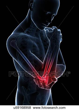 Stock Illustration - Human elbow pain, illustration. Fotosearch