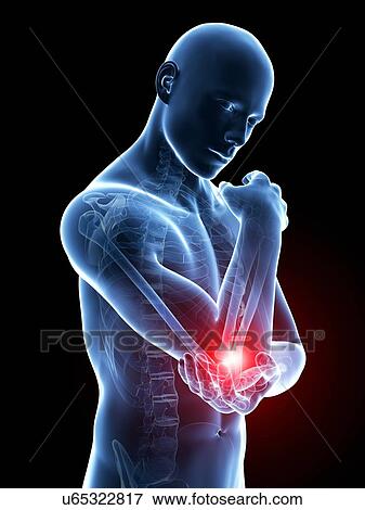Stock Illustration - Human elbow pain, illustration. Fotosearch