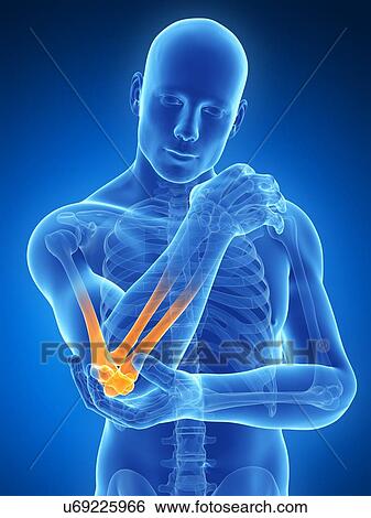 Stock Illustration - Human elbow pain, illustration. Fotosearch