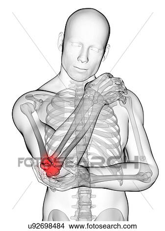Human elbow pain, illustration View Large Illustration Stock Illustration - Human elbow pain, illustration. Fotosearch