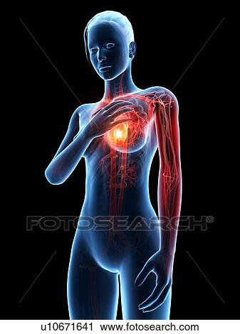 Human heart attack, illustration View Large Illustration Clip Art - Human heart attack, illustration. Fotosearch