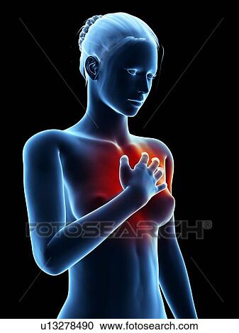 Human heart attack, illustration View Large Illustration Clipart - Human heart attack, illustration. Fotosearch