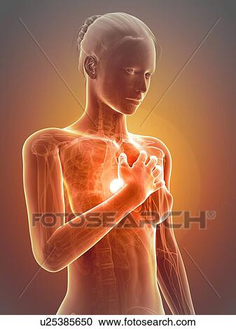 Human heart attack, illustration View Large Illustration Clipart - Human heart attack, illustration. Fotosearch