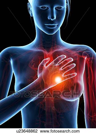 Human heart attack, illustration View Large Illustration Drawing - Human heart attack, illustration. Fotosearch