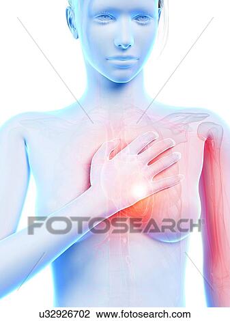 Human heart attack, illustration View Large Illustration Drawing - Human heart attack, illustration. Fotosearch