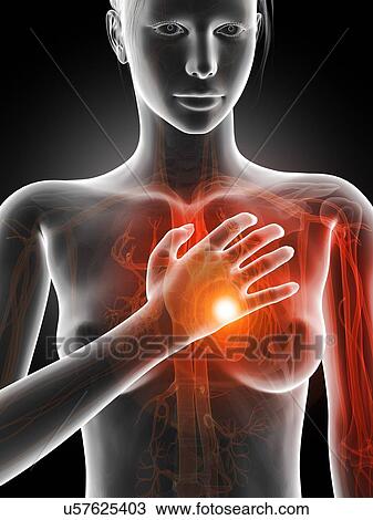 Human heart attack, illustration View Large Illustration Drawing - Human heart attack, illustration. Fotosearch
