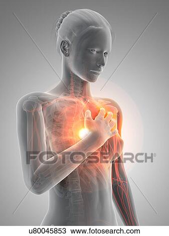 Human heart attack, illustration View Large Illustration Drawing - Human heart attack, illustration. Fotosearch
