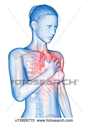 Human heart attack, illustration View Large Illustration Stock Illustration - Human heart attack, illustration. Fotosearch