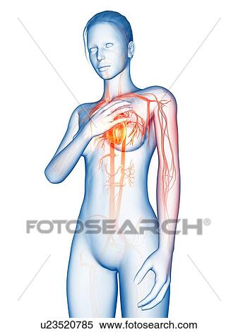 Human heart attack, illustration View Large Illustration Stock Illustration - Human heart attack, illustration. Fotosearch