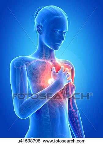Stock Illustration - Human heart attack, illustration. Fotosearch