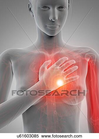 Human heart attack, illustration View Large Illustration Stock Illustration - Human heart attack, illustration. Fotosearch