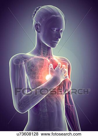 Stock Illustration - Human heart attack, illustration. Fotosearch