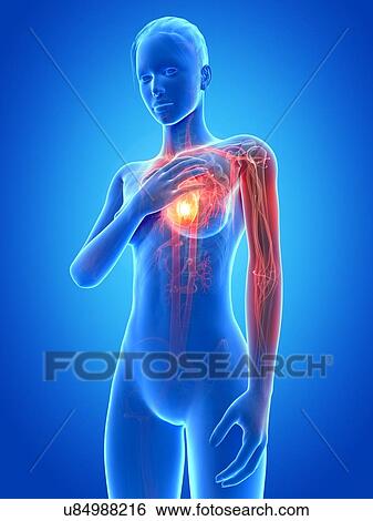 Human heart attack, illustration View Large Illustration Stock Illustration - Human heart attack, illustration. Fotosearch