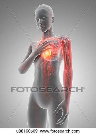 Human heart attack, illustration View Large Illustration Stock Illustration - Human heart attack, illustration. Fotosearch