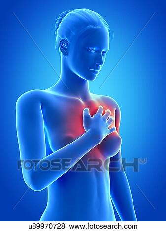 Human heart attack, illustration View Large Illustration Stock Illustration - Human heart attack, illustration. Fotosearch