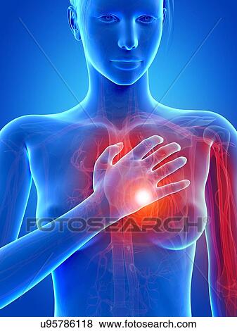 Human heart attack, illustration View Large Illustration Stock Illustration - Human heart attack, illustration. Fotosearch