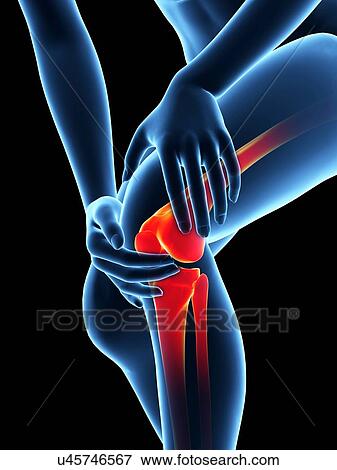 Stock Illustration - Human knee pain, illustration. Fotosearch